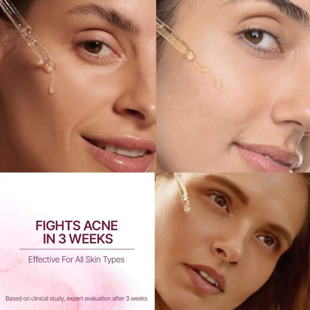 A picture showing 3 girls on their faces showing 3 different skin types with caption "FIGHTS ACNE IN 3 WEEKS - Effective For All Skin types"
